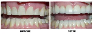Before and After testimonials at House of Smiles 